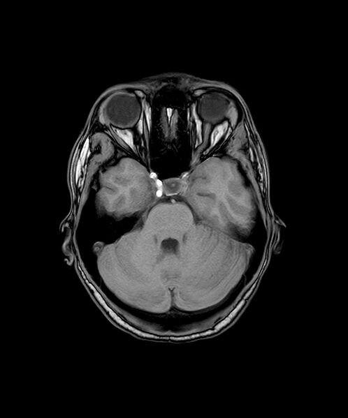 File:Angiomatous meningioma (Radiopaedia 79459-92577 Axial T1 FFE 8).jpg