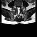 Ankylosing spondylitis with zygapophyseal arthritis (Radiopaedia 38433-40517 C 14).jpg