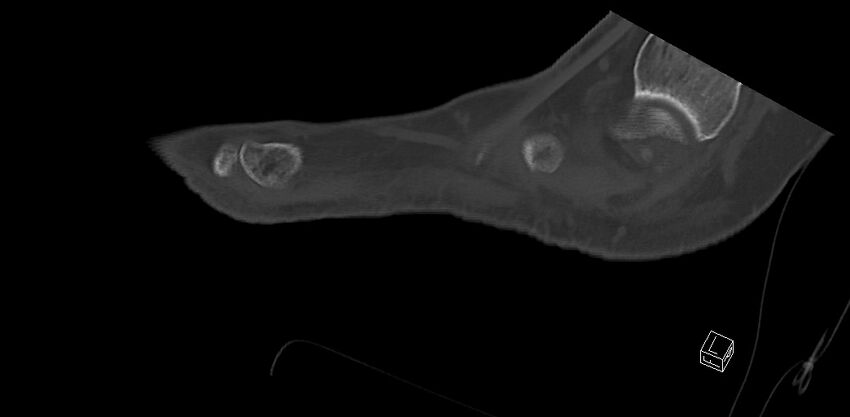 Anterior calcaneal process fracture (Radiopaedia 63353-71943 C 50).jpg