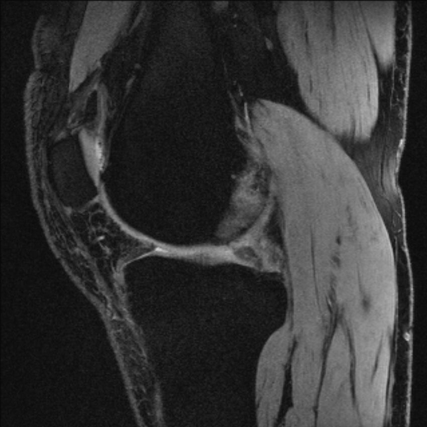 Anterior cruciate ligament mucoid degeneration (Radiopaedia 68400-77933 Sagittal 40).jpg