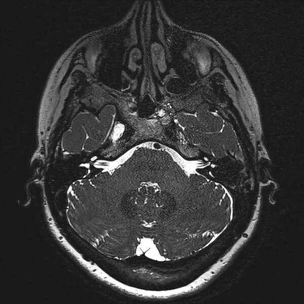 File:Anterior temporal encephalocele (Radiopaedia 82624-96808 Axial T2 high res 17).jpg
