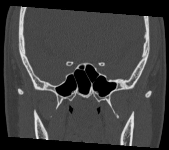 File:Antrochoanal polyp (Radiopaedia 21894-21868 Coronal bone window 28).jpg