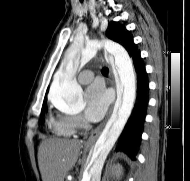 File:Aortic dissection - Stanford type A (Radiopaedia 29247-29659 C 25).jpg