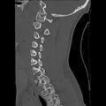 Apical pneumothorax on cervical spine CT (Radiopaedia 45343-49368 Sagittal bone window 23).jpg
