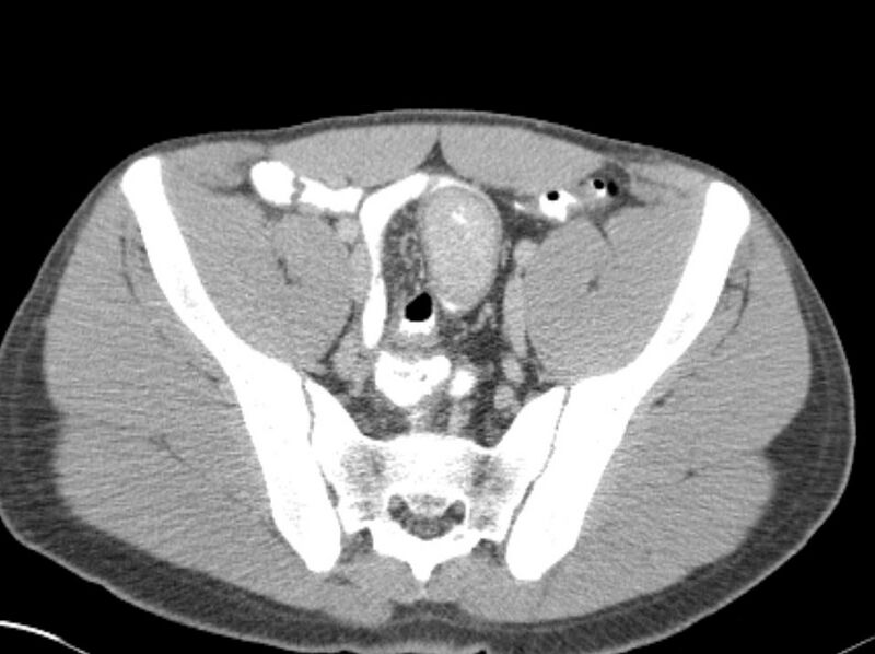 File:Appendicitis and incidental foregut duplication cyst (Radiopaedia 52962-58916 A 76).jpg