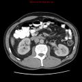 Appendicitis and renal cell carcinoma (Radiopaedia 17063-16760 A 24).jpg