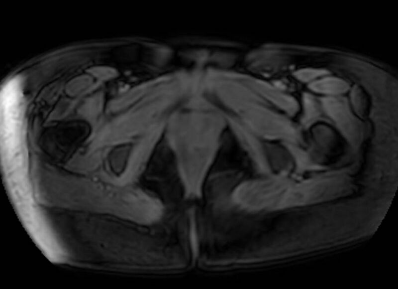 File:Appendicitis in gravida (MRI) (Radiopaedia 89433-106395 Axial DIXON 155).jpg