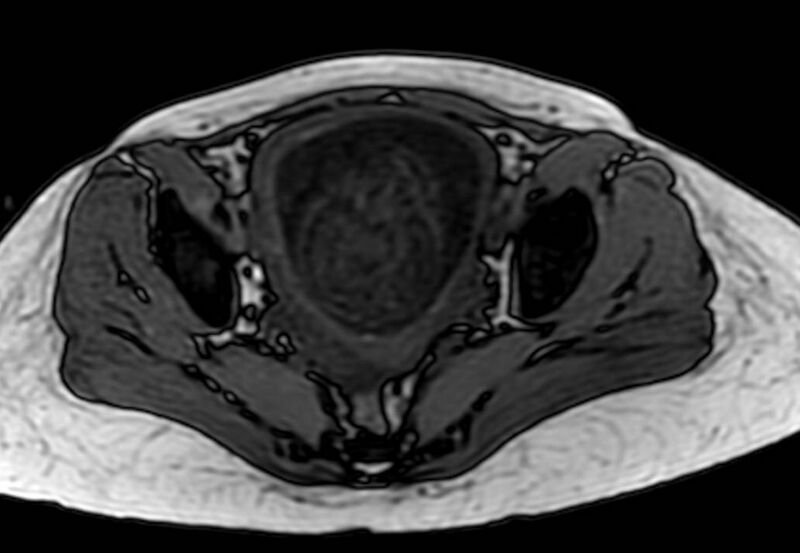 File:Appendicitis in gravida (MRI) (Radiopaedia 89433-106395 D 60).jpg