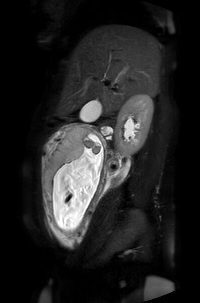 File:Appendicitis in gravida (MRI) (Radiopaedia 89433-106395 Sagittal T2 SPAIR 44).jpg