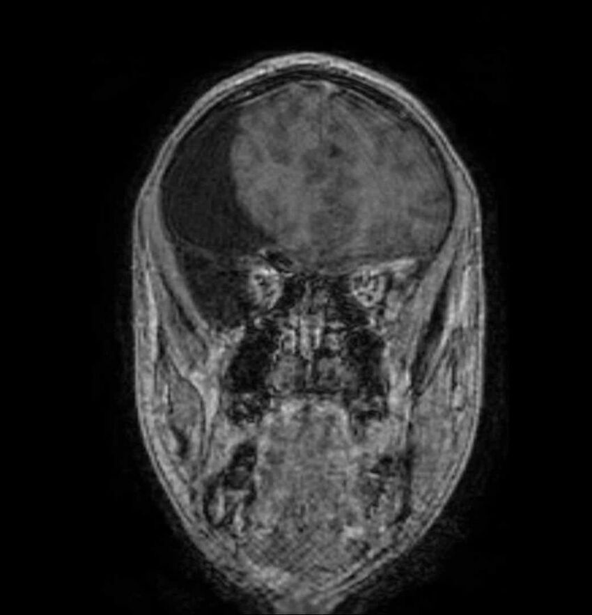 Arachnoid cyst- extremely large (Radiopaedia 68741-78451 Coronal T1 C+ 24).jpg