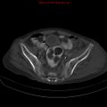Arachnoiditis ossificans (Radiopaedia 51394-57136 Axial bone window 36).jpg
