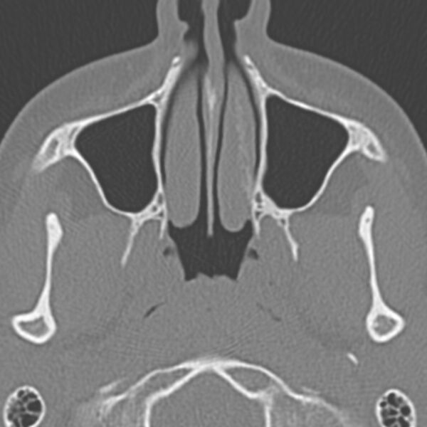 File:Arrested pneumatization of the sphenoid (Radiopaedia 10700-11172 Axial non-contrast 16).jpg