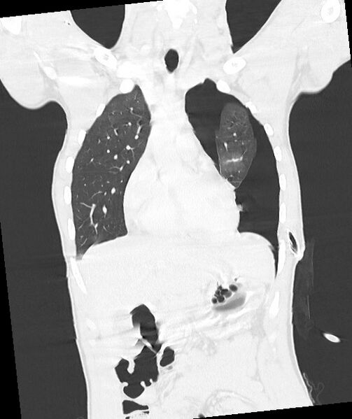 File:Arrow injury to the chest (Radiopaedia 85367-100975 Coronal lung window 61).jpg