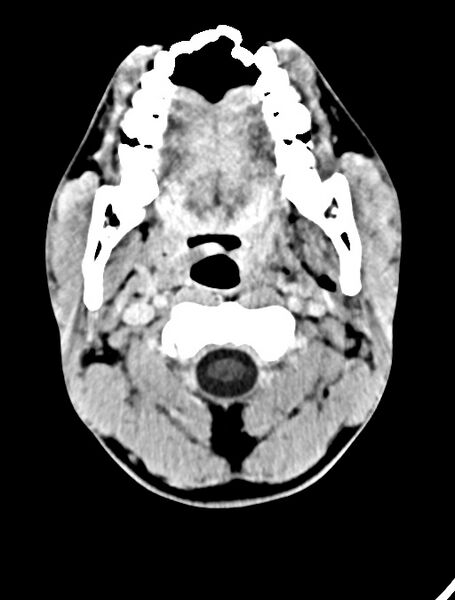 File:Arrow injury to the face (Radiopaedia 73267-84011 Axial C+ delayed 23).jpg