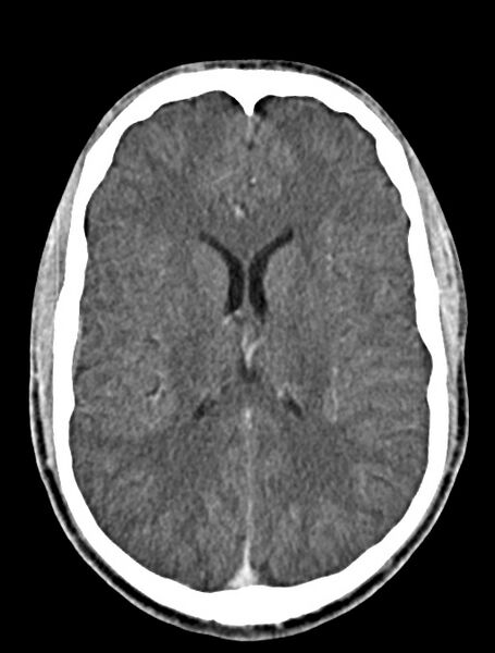 File:Arrow injury to the face (Radiopaedia 73267-84011 Axial C+ delayed 58).jpg