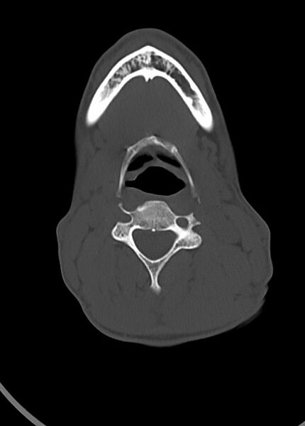 File:Arrow injury to the head (Radiopaedia 75266-86388 Axial bone window 13).jpg