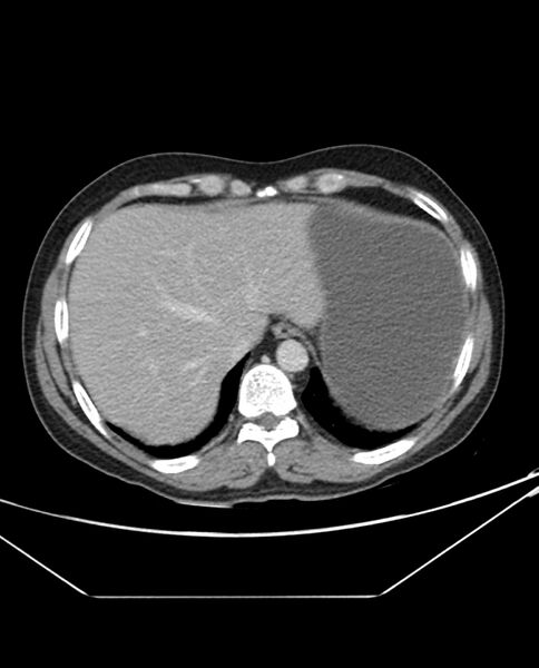 File:Arterial occlusive mesenteric ischemia (Radiopaedia 84641-100054 A 15).jpg