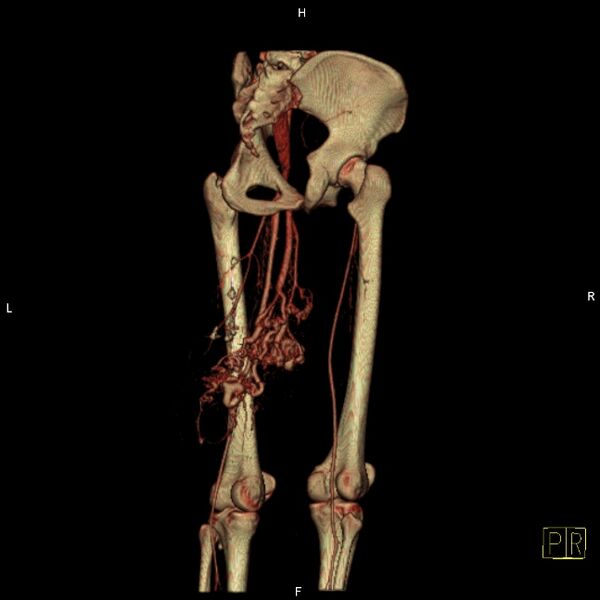 File:Arteriovenous malformation of the thigh (Radiopaedia 14948-14883 C 6).jpg
