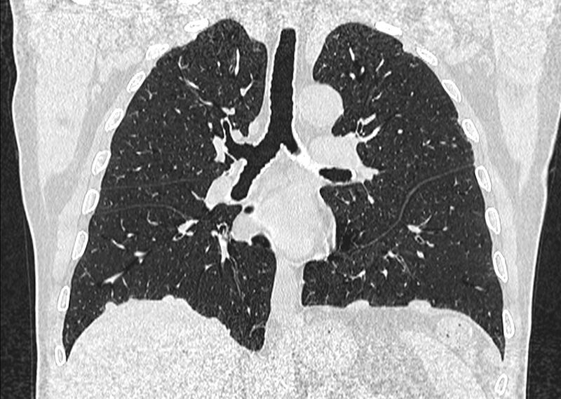 File:Asbestos pleural placques (Radiopaedia 57905-64872 Coronal lung window 155).jpg