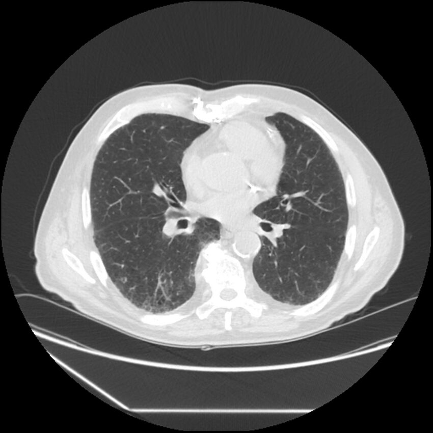 Asbestosis complicated by lung cancer (Radiopaedia 45834-50116 Axial lung window 38).jpg
