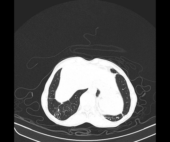 File:Aspergillomas (Radiopaedia 66779-76110 Axial lung window 43).jpg