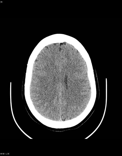 File:Astroblastoma (Radiopaedia 39792-42216 Axial non-contrast 33).jpg