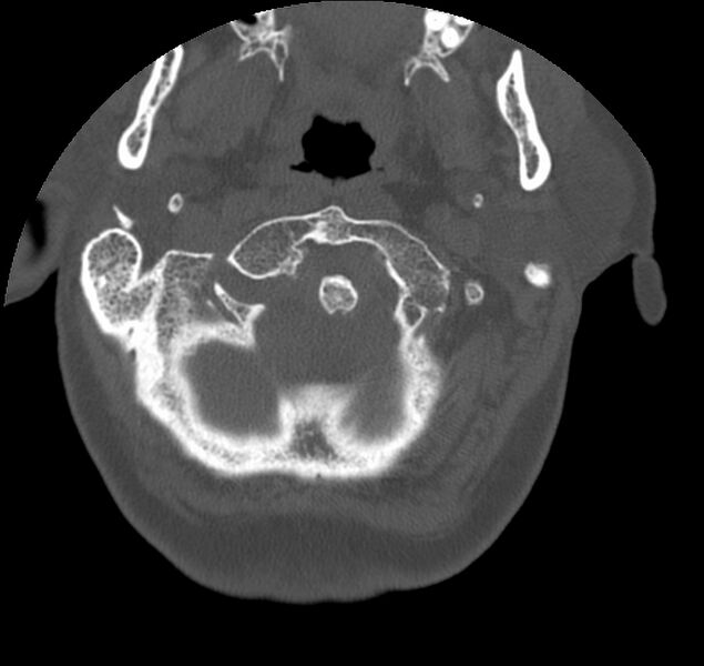 File:Atlanto-occipital assimilation with basilar invagination (Radiopaedia 70122-80188 Axial bone window 14).jpg