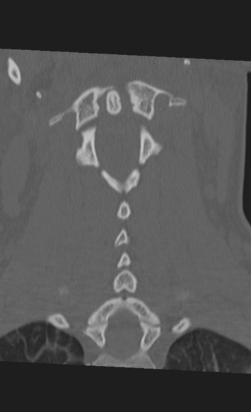 File:Atlanto-occipital dissociation (Radiopaedia 33848-35013 Coronal bone window 28).png