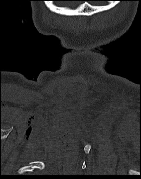 File:Atlanto-occipital dissociation - Traynelis type 1 (Radiopaedia 87570-103948 Coronal bone window 59).jpg