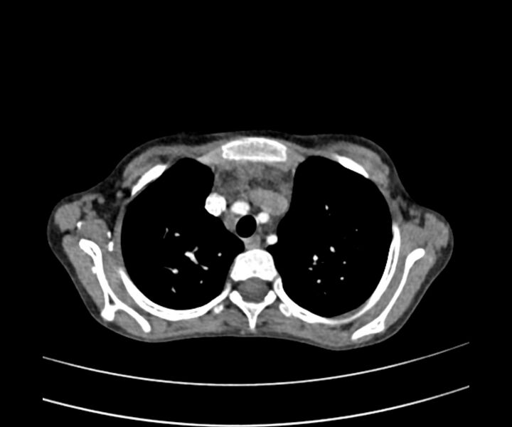 File:Atrial septal defect complicated by Eisenmenger syndrome (Radiopaedia 53707-59768 Axial C+ CTPA 7).jpg