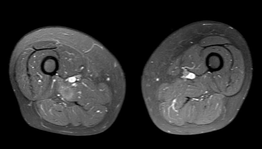 Atypical lipomatous tumor - thigh (Radiopaedia 68975-78734 Axial PD fat sat 46).jpg