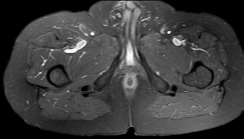 Atypical lipomatous tumor - thigh (Radiopaedia 68975-78734 Axial PD fat sat 81).jpg