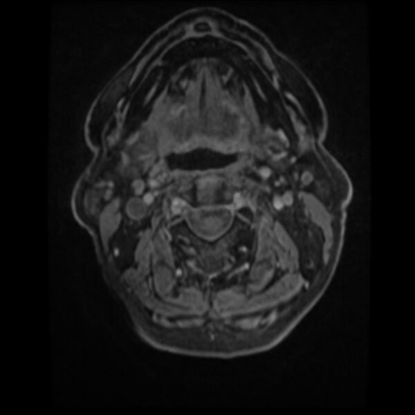File:Atypical meningioma (Radiopaedia 45535-49629 Axial T1 C+ 3).jpg