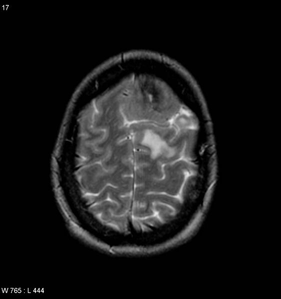 File:Atypical meningioma (WHO grade II) (Radiopaedia 7762-8586 Axial T2 9).jpg