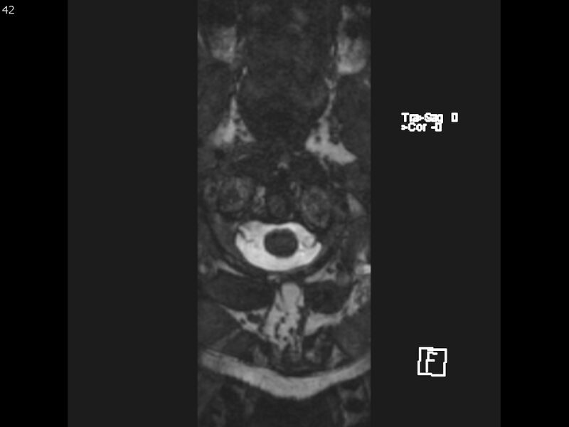 File:Atypical meningioma - intraosseous (Radiopaedia 64915-74572 Axial CISS 42).jpg