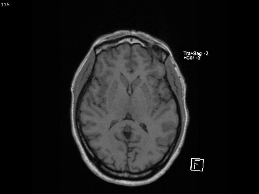 Atypical meningioma - intraosseous (Radiopaedia 64915-74572 Axial T1 115).jpg