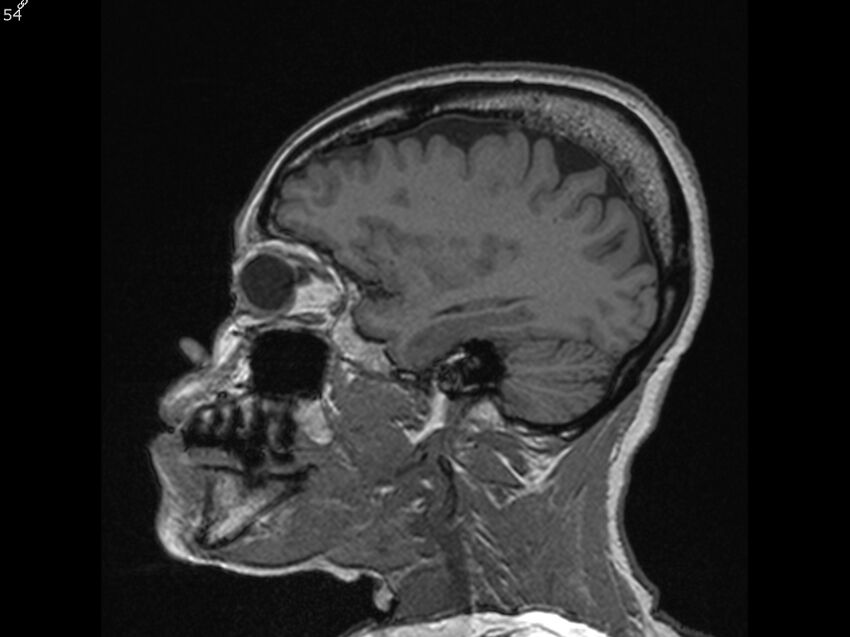 Atypical meningioma - intraosseous (Radiopaedia 64915-74572 Sagittal T1 54).jpg