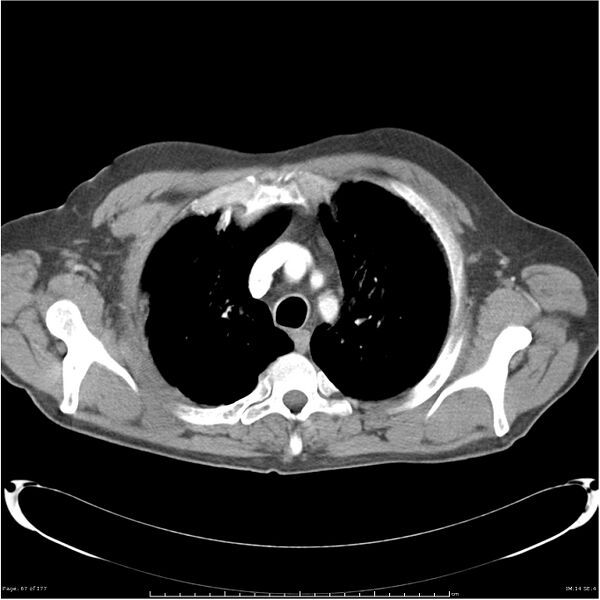 File:Atypical pneumonia - Q fever (Radiopaedia 21993-21989 C+ arterial phase 9).jpg