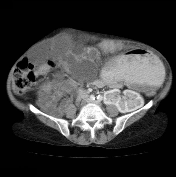 File:Autosomal dominant polycystic kidney disease (Radiopaedia 16777-16490 A 37).jpg