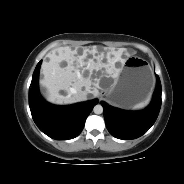 File:Autosomal dominant polycystic kidney disease (Radiopaedia 23061-23093 C 10).jpg