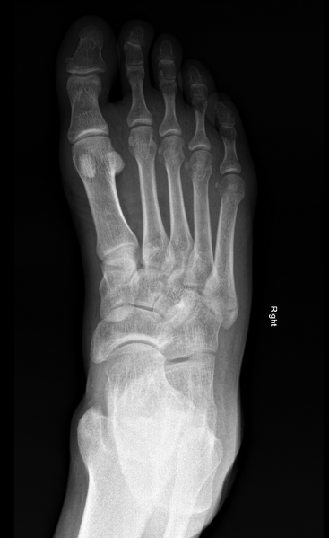 File:Avulsion fracture of the 5th metatarsal styloid - pseudo-Jones fracture (Radiopaedia 63079-71569 Frontal 1).PNG