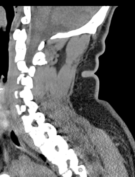 File:Axis peg fracture (type 3) and atlas lateral mass (type 4) fracture (Radiopaedia 37474-39324 D 32).png