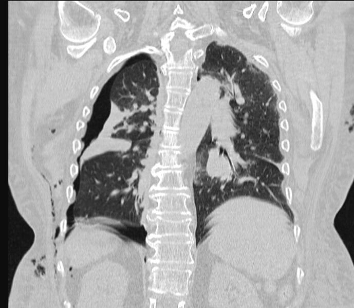 File:Barotrauma due to mechanical ventilation (Radiopaedia 28079-28336 Coronal lung window 66).jpg