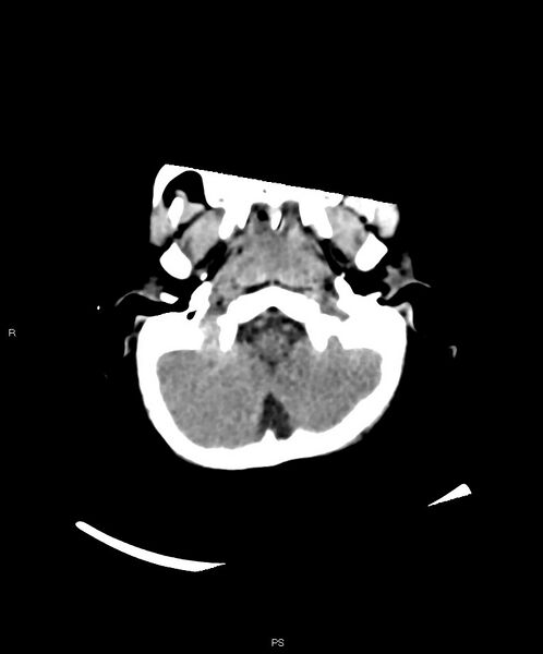 File:Basal ganglia and parenchymal ischemia (Radiopaedia 45818-50083 Axial non-contrast 39).jpg