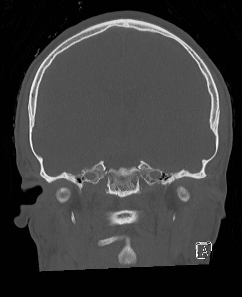 File:Base of skull fracture with bilateral Le Fort fractures (Radiopaedia 47094-51638 Coronal bone window 48).jpg