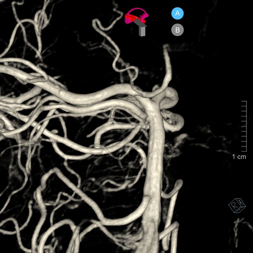 Basilar artery perforator aneurysm (Radiopaedia 82455-97734 3D view left VA 129).jpg