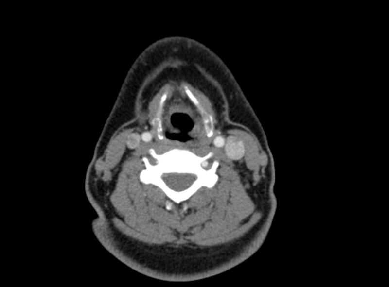 File:Benign mixed salivary tumor of the parotid gland (Radiopaedia 35261-36792 A 32).jpg