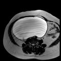 Benign seromucinous cystadenoma of the ovary (Radiopaedia 71065-81300 B 22).jpg