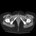 Bicornuate uterus- on MRI (Radiopaedia 49206-54296 Axial non-contrast 17).jpg
