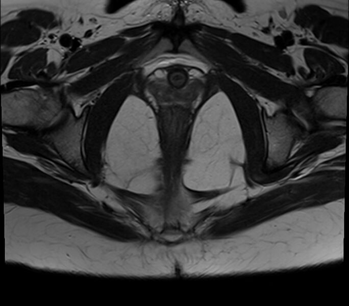 File:Bicornuate uterus (Radiopaedia 71214-81511 Axial T2 6).jpg